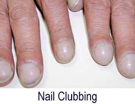 Fingernail Problems: White, Curved or Clubbed Nails - Macomb Hand Surgery