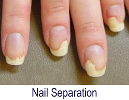 Fingernails Possible Problems  Dr Walias Skin And Laser Clinic