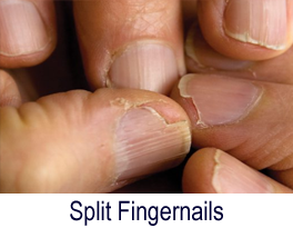 Finger nail problems  rcalmhands
