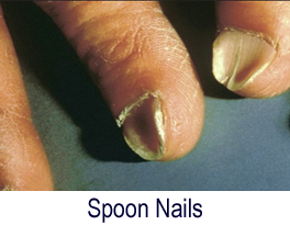 Fingernail Problems White Curved Or Clubbed Nails Macomb Hand Surgery
