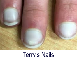 Fingernail Problems White Curved Or Clubbed Nails Macomb Hand Surgery