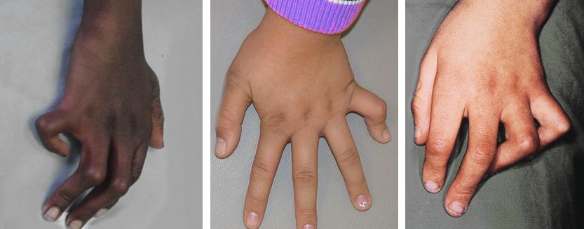 Camptodactyly (Bent Fingers) In Children - Macomb Hand Surgery